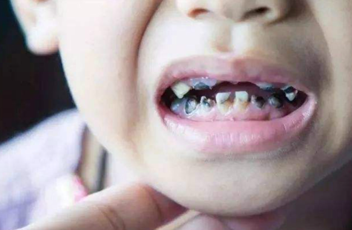 三岁孩子满嘴烂牙,罪魁祸首不是食物,而是一种宝宝必备的餐具